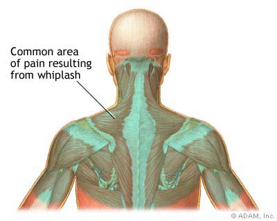 neck and upper back pain of whiplash